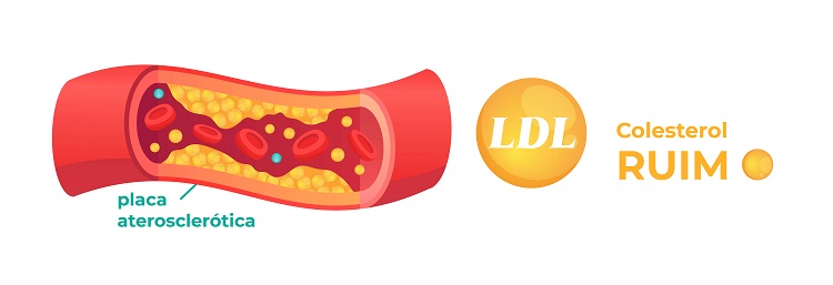  Ilustração do Colesterol LDL bloqueando artéria