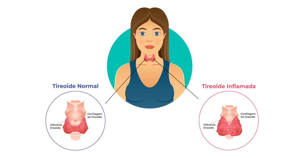 Ilustração comparando glândula da tireoide saudável com outra inflamada 