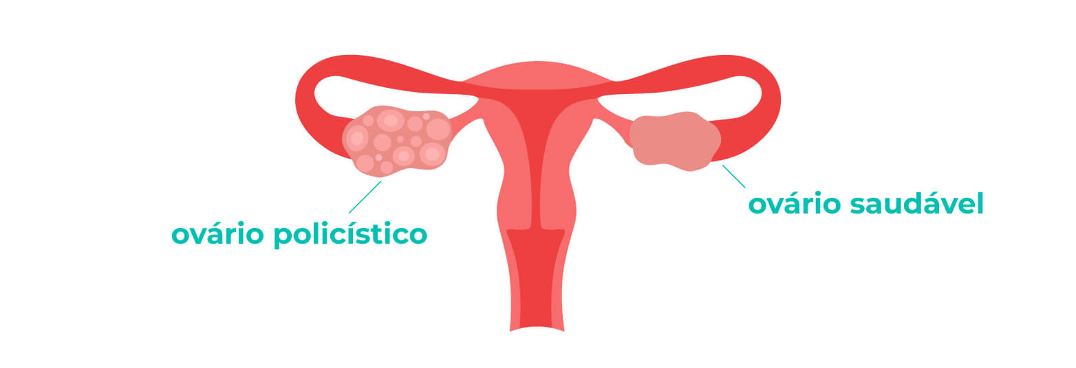 Atraso Menstrual - Por que Acontece?