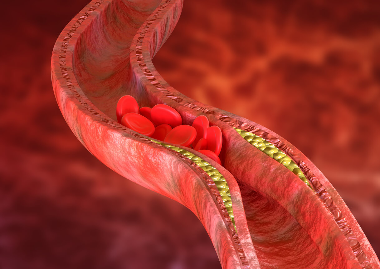 Aterosclerose por acúmulo de gordura nas artérias