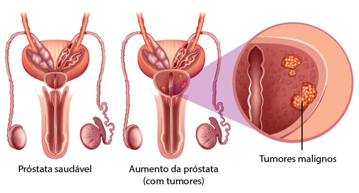  Ilustração dos sintomas do câncer de próstata